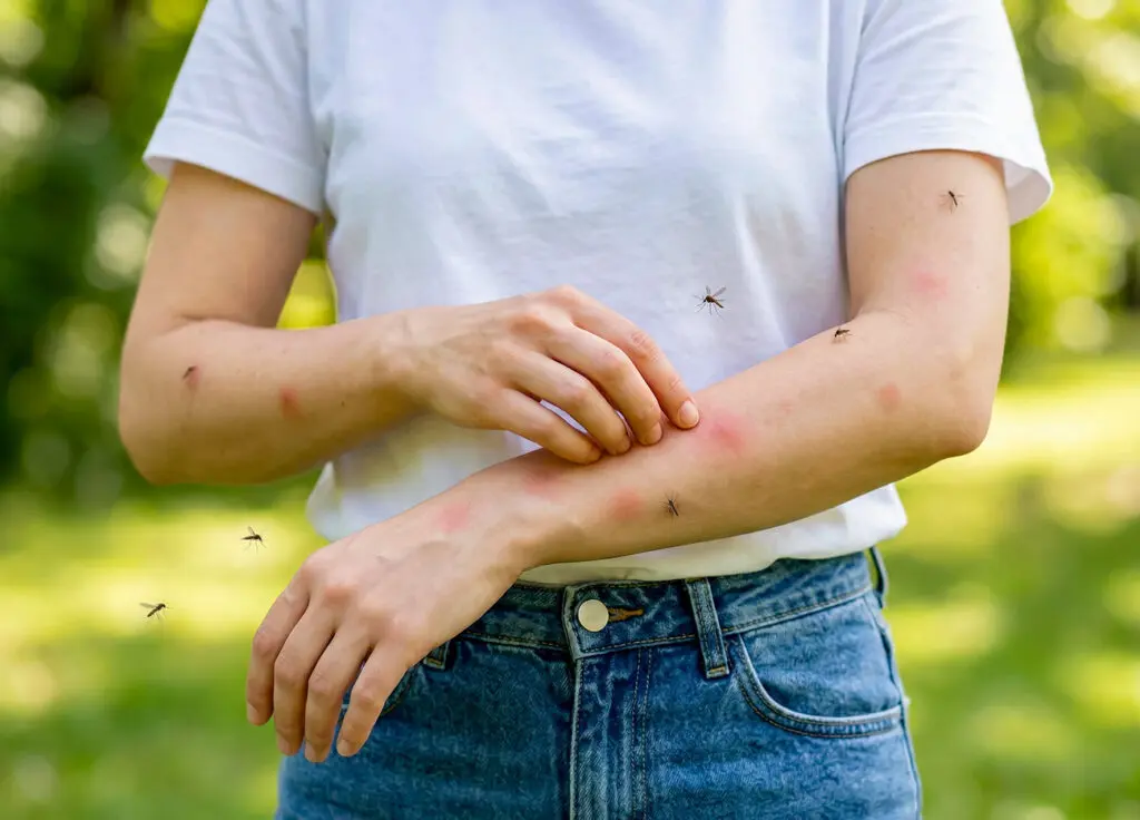 Person with mosquito bites in their PA backyard